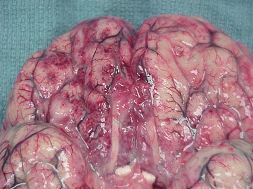 Hemorrhagic necrosis of brain tissue due to Naegleria fowleri infection.