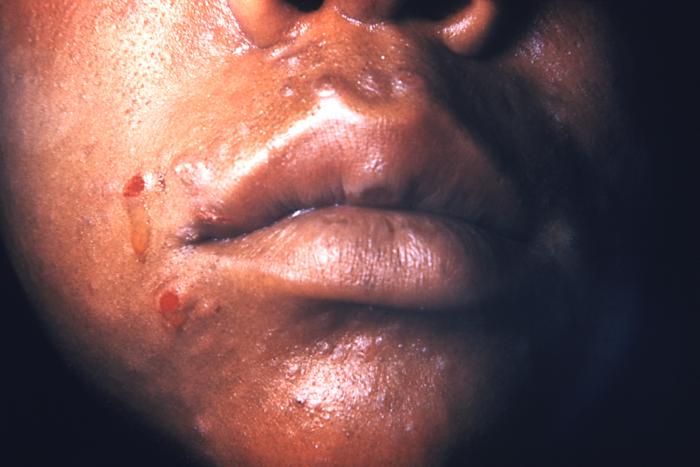 This patient presented with secondary syphilitic lesions of the lips. Note the split papules at the angles of the mouth. Second-stage symptoms can include fever, swollen lymph glands, sore throat, patchy hair loss, headaches, weight loss, muscle aches, and tiredness. A person can easily pass the disease to sex partners during the primary or secondary stage of the disease. Adapted from CDC