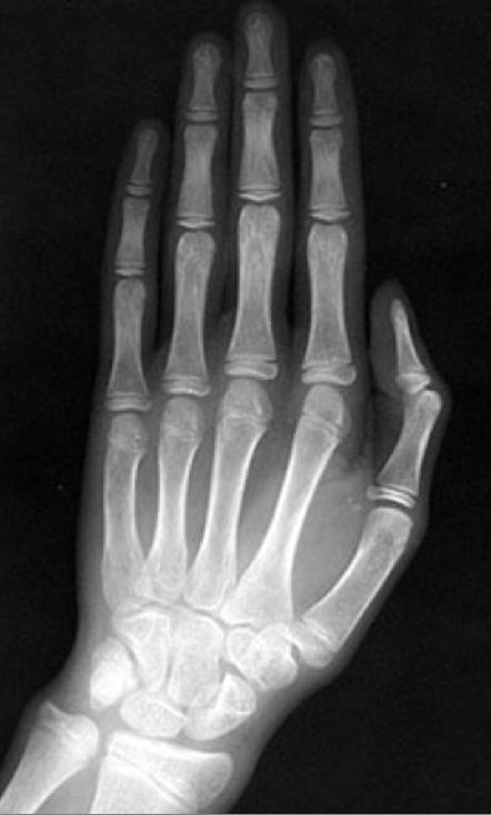 Normal contralateral hand