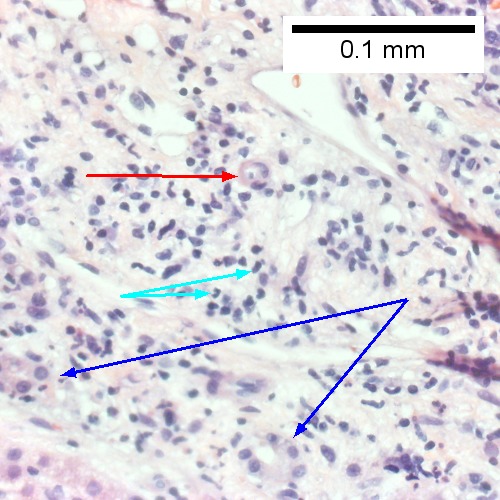 D. The epithelium of the ducts can be severely degenerated. Neutrophils (cyan arrows) invade epithelium of an interlobular duct that are recognizable mainly as a circle of rounded nuclei; the associated arteriole (red arrow) should be identified to ensure an interlobular duct is being evaluated. Note the proliferated bile ductules (blue arrows).