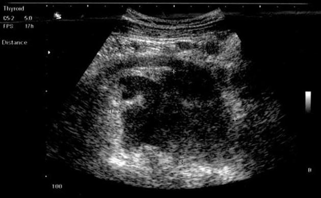File:Anaplastic large cell lymphoma Ultrasound.JPG