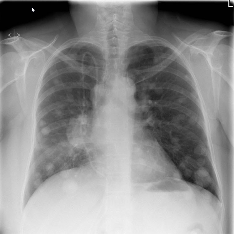 File:Lung cancer-2.jpg