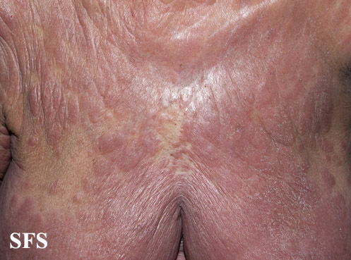 File:Mycosis fungoides 10.jpg