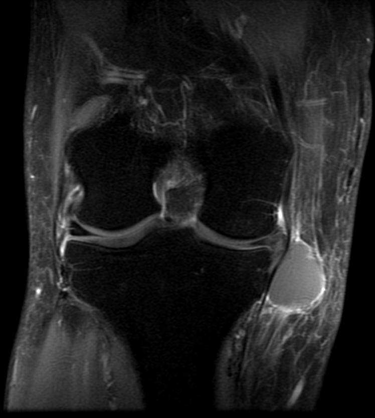 File:Parameniscal cyst MRI 003.jpg
