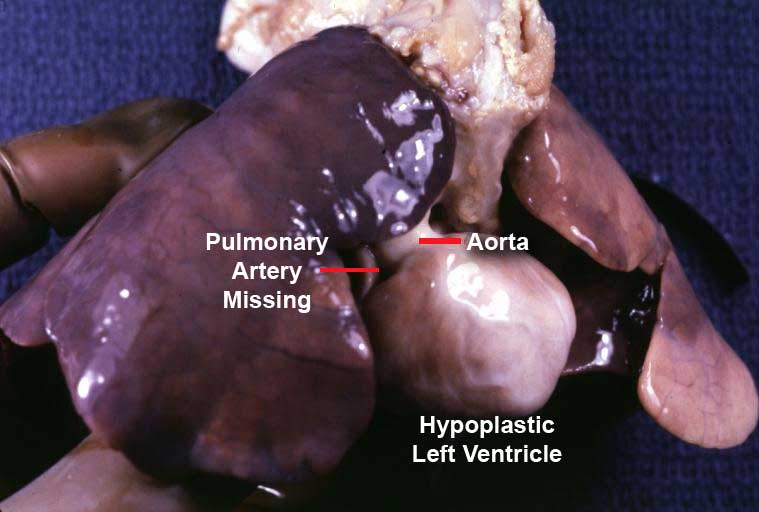 Only an aorta can be seen originating from this pathology specimen. No pulmonary artery is present.