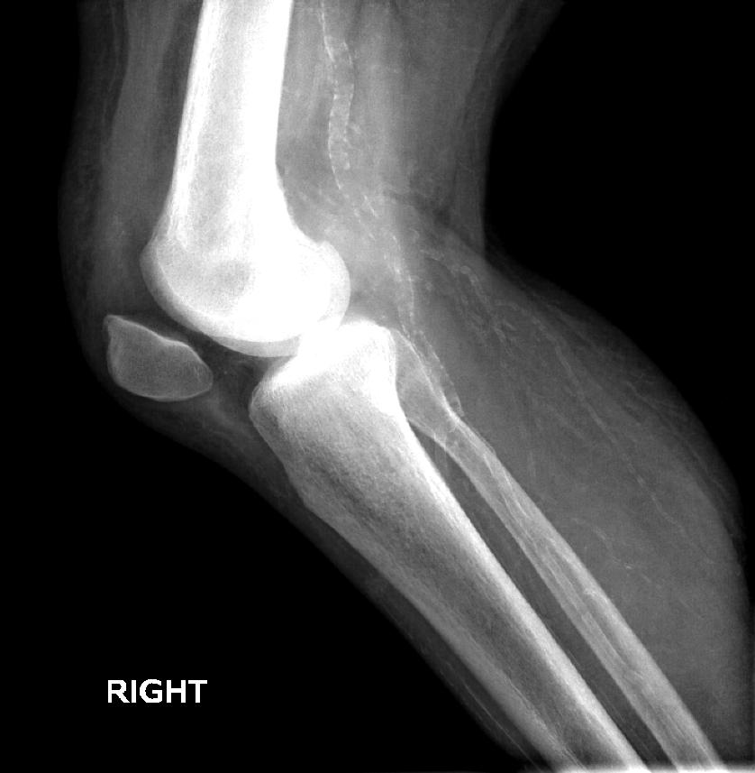 File:Quadriceps tendon rupture 001.jpg
