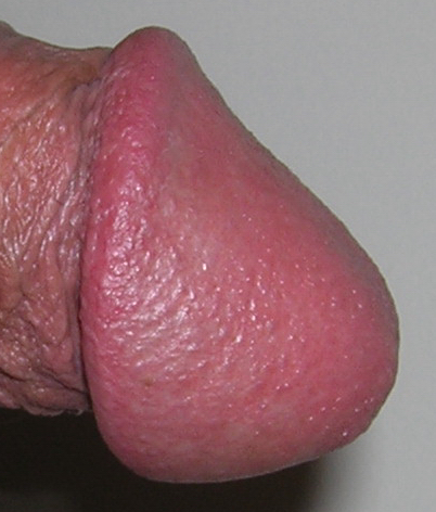 Side view circumcised glans penis