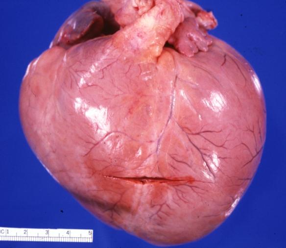 Cardiomyopathy: Gross globular heart external view 10 year old girl with sickle cell anemia