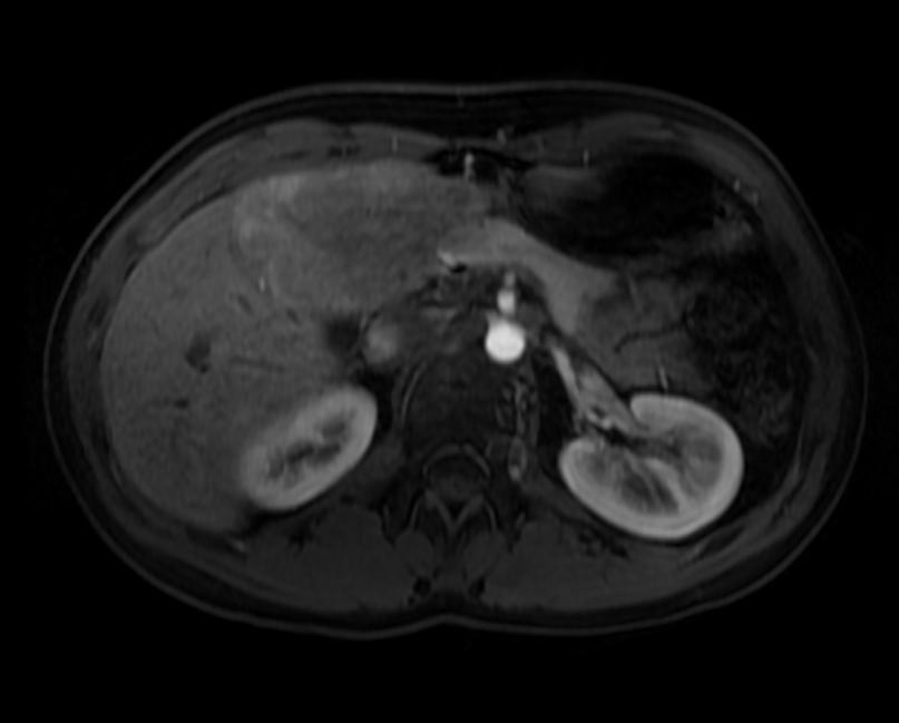T1 fat sat arterial: A patient with multiple adenoma