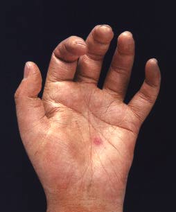 File:Janeway lesion due to endocarditis.jpg