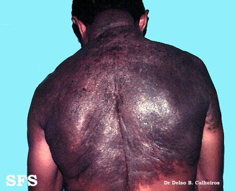 Naevus giant pigmented. Adapted from Dermatology Atlas.[1]