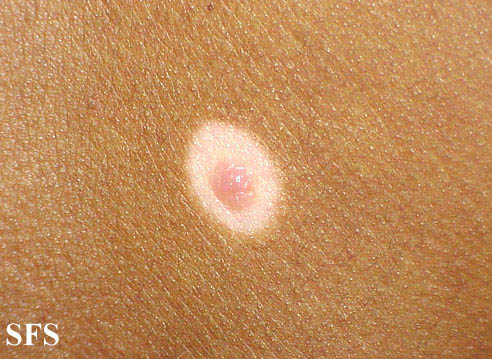 Naevus halo. Adapted from Dermatology Atlas.[4]