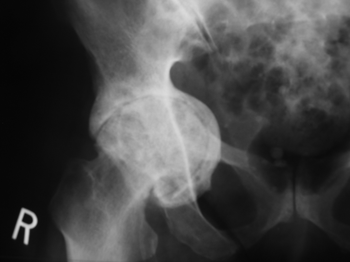 File:Renal osteodystrophy.png