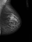 Mammogram of Mastitis - Case courtesy of Dr Maxime St-Amant, Radiopaedia.org, rID: 26843
