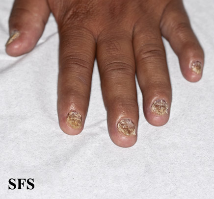 Nails showing pitting, crumbling and brittleness, courtesy http://www.atlasdermatologico.com.br/