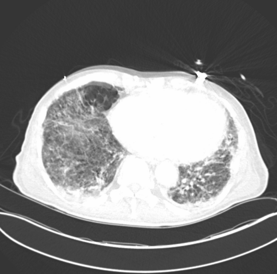 File:Pneumocystis jirovecii pneumonia CT.png
