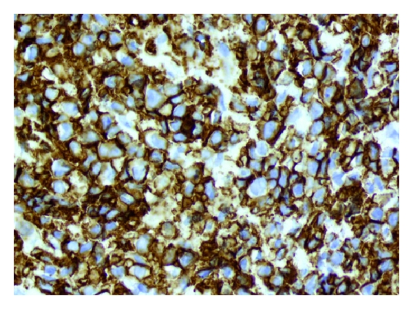 File:Primary medistinal large b-cell lymphoma pathology 1 .jpg