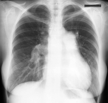 This is a posteroanterior radiograph revealing enlarged pulmonary arteries in a patient with atrial septal defect.