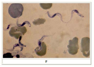 African trypanosomiasis 6