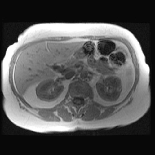MRI: Angiomyolipoma Image courtesy of Radswiki Radiopaedia(original file "here"). Creative Commons BY-SA-NC[1]