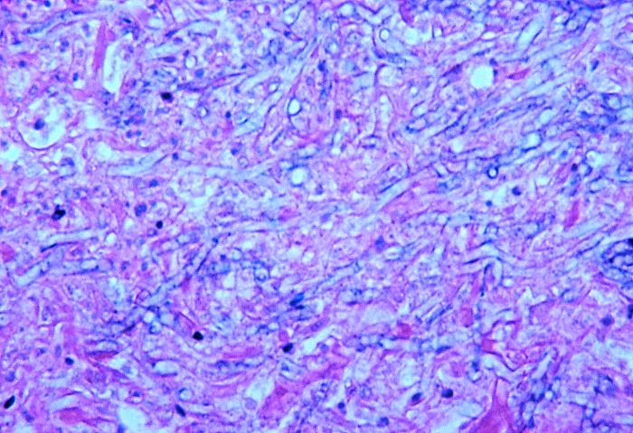 Note the histopathologic changes seen in aspergillosis of the lung of a caged parrot using H&E stain, which shows fungal hyphae. From Public Health Image Library (PHIL). [2]