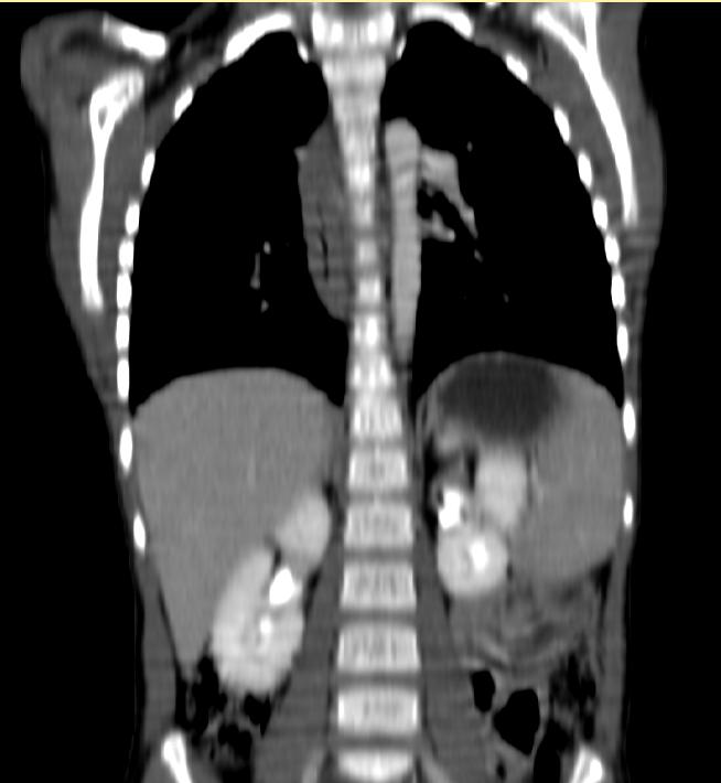 File:Esophageal leiomyomatosis CT 003.jpg