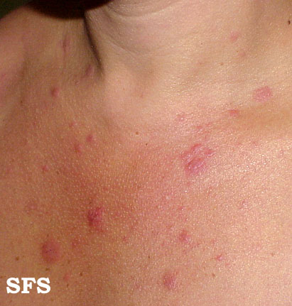 Polymorphic light eruption. With permission from Dermatology Atlas.[1]