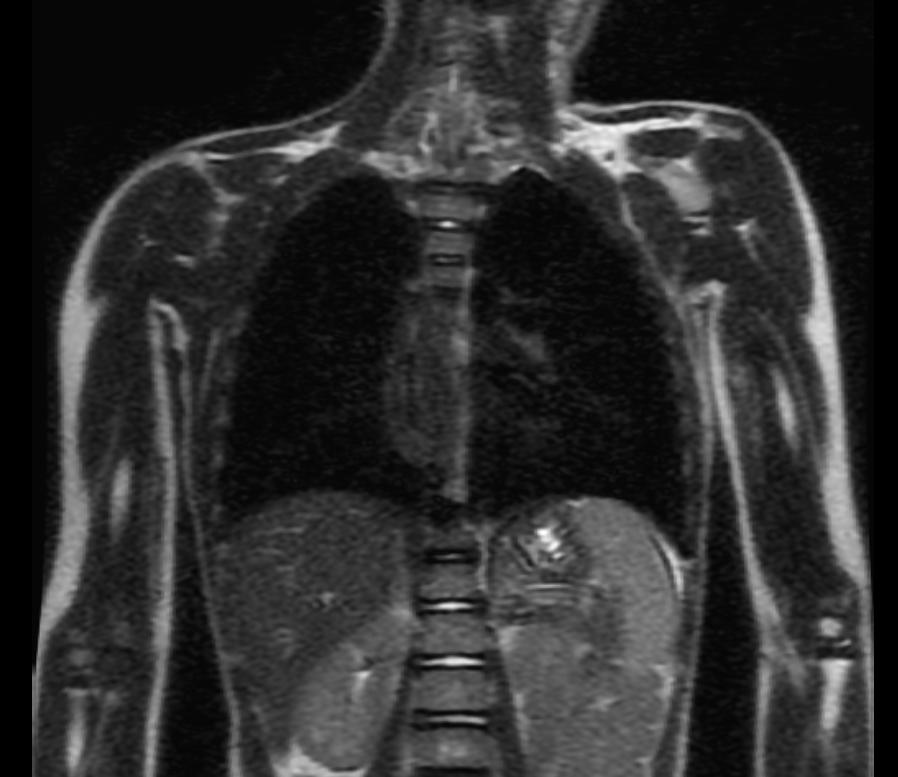 File:Esophageal leiomyomatosis MRI 001.jpg