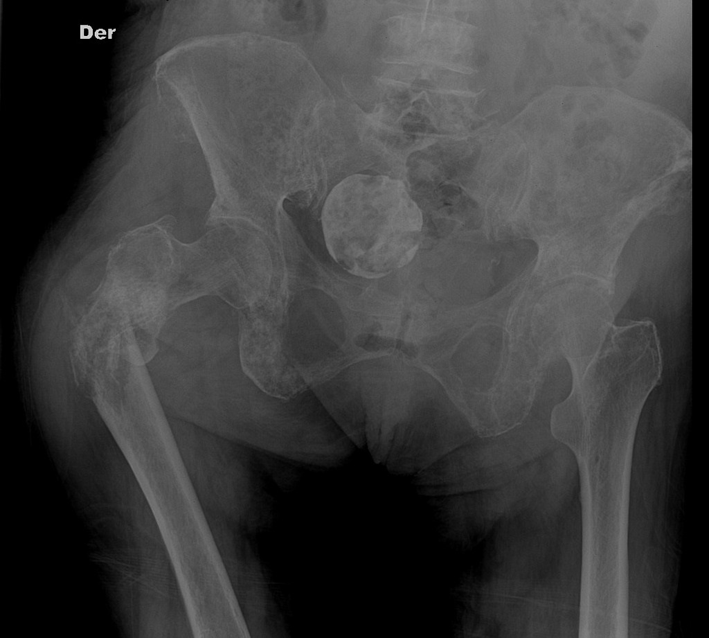Pathologic fracture of the left proximal femur. Note the extensive bone metastases. A rounded calcified mass in the right side of the pelvis is consistent with an old calcified uterine fibroid.