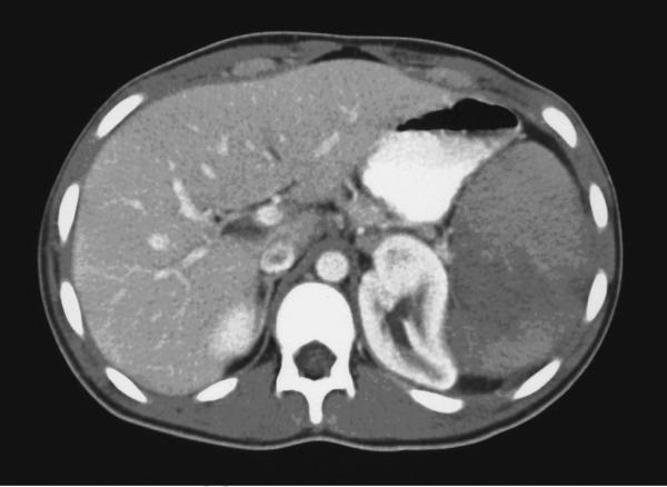 CT of the abdomen in a patient with sickle cell disease. Shown are splenic infarcts.