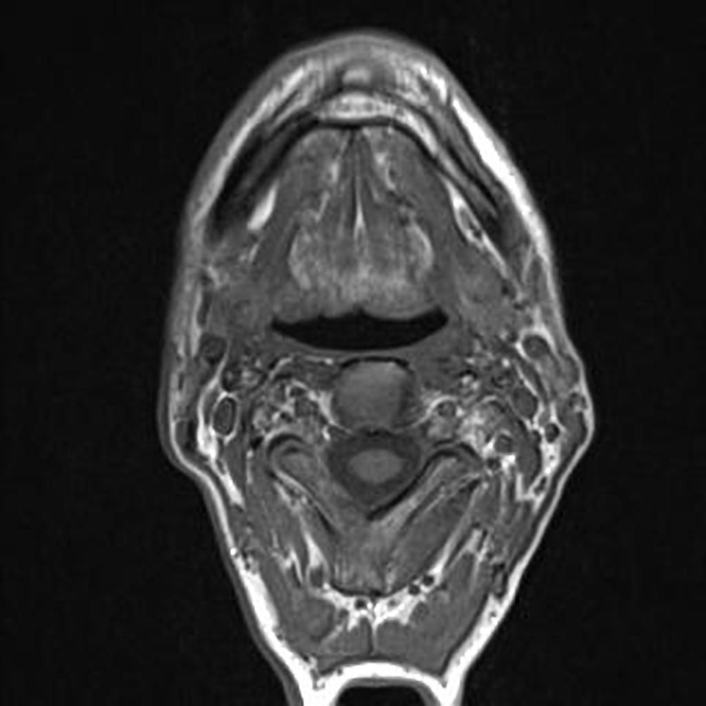 MRI of Transglottic squamous cell carcinoma[2]
