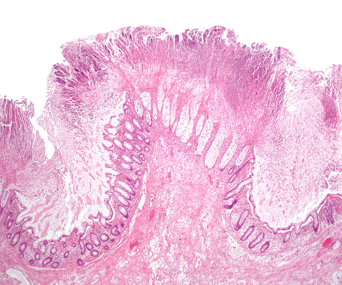 Pseudomembranous colitis. H& E staining showing pseudomembranes in Clostridium colitis [41]
