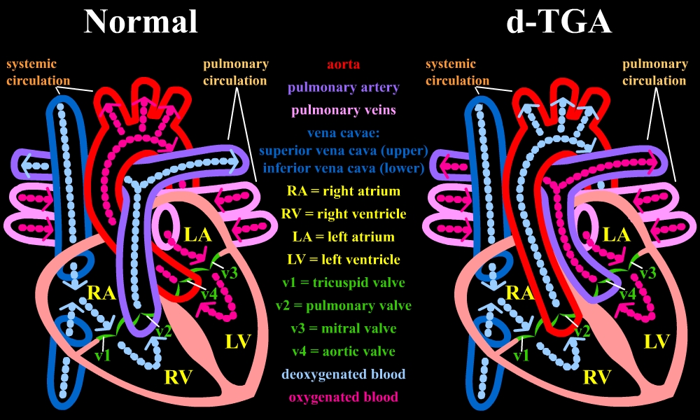 Normal heart anatomy compared to d-TGA