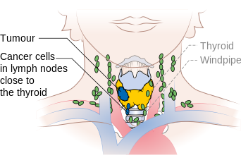 Diagram showing stage N1a thyroid cancer CRUK 242.png