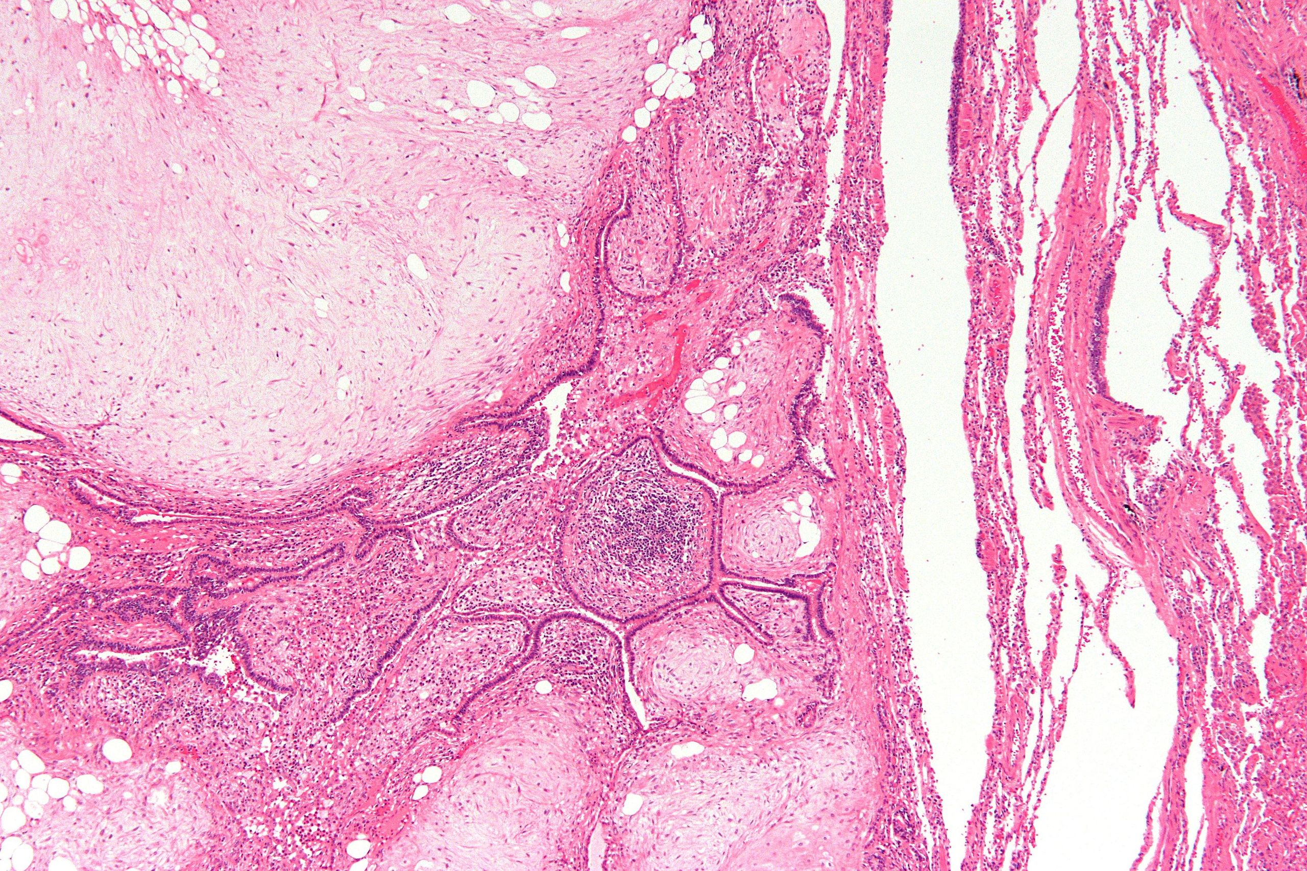 Low magnification micrograph of a pulmonary hamartoma. H&E stain.[12]