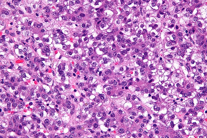 Very high magnification micrograph of a hepatoblastoma, a type of liver cancer found in infants and young children. H&E stain.[6]