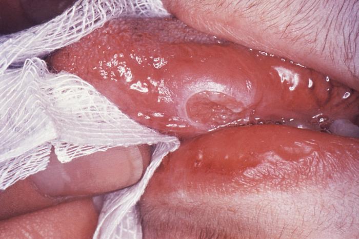 Left lateral margin of a tongue of a tuberculosis patient, which had been retracted in order to reveal the lesion that had been caused by the Gram-positive bacterium Mycobacterium tuberculosisAdapted from Public Health Image Library (PHIL), Centers for Disease Control and Prevention.[36]