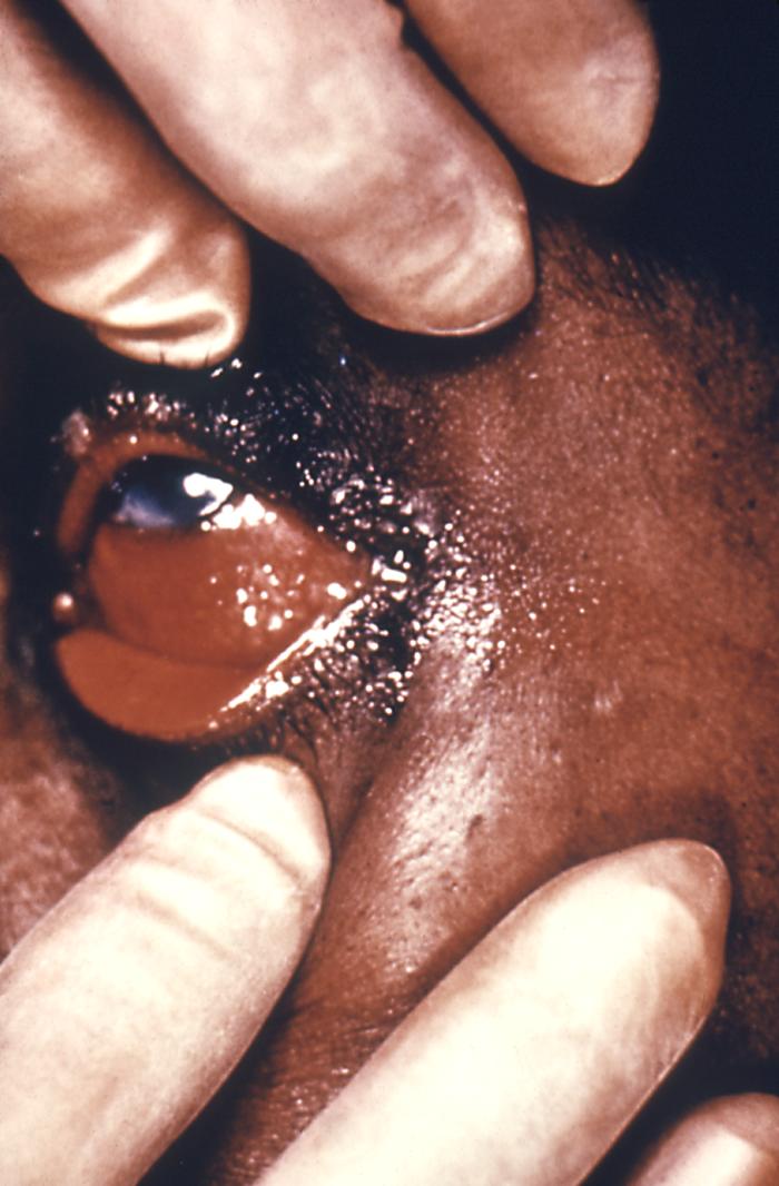 A highly contagious infection, gonococcal ophthalmia is due the pathogenic bacteria Neisseria gonorrhoeae.This case involved an adult patient with a systemically disseminated gonococcal infection, but neonates are in danger of acquiring this ophthalmic infection at the time of their delivery when the mother is infected with N. gonorrhoeae bacteria.Adapted from CDC