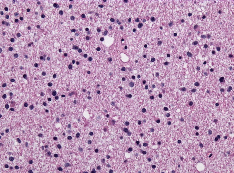 File:800px-Diffuse astrocytoma HE stain.jpg
