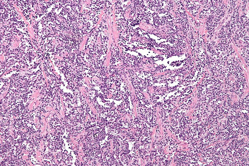File:Alveolar rhabdomyosarcoma - intermed mag.jpg