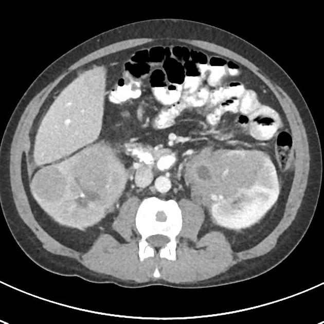 Multiple mass lesions are demonstrated within the hepatic parenchyma with the largest lying in segment 2 and this appears to have several associated mass lesions adjacent to it.[6]