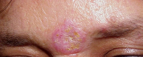Discoid lupus erythematosus. Adapted from Dermatology Atlas.[21]