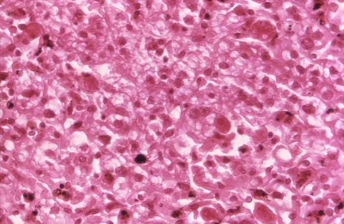 Transmission electron micrograph (TEM) reveals the presence of numerous St. Louis encephalitis virions that were contained within a central nervous system tissue sample. From Public Health Image Library (PHIL). [2]