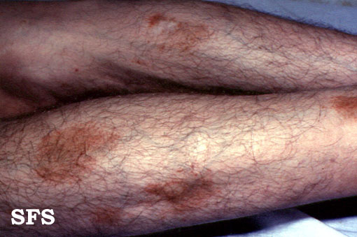 Majocchi’s disease. Adapted from Atlas<ref name="www.atlasdermatologico.com.br">"Dermatology Atlas".