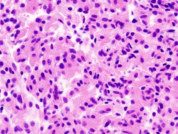 Histopathological image of pituitary adenoma with GH production. Acidophilic cell type. Hematoxylin & esoin stain.[2]