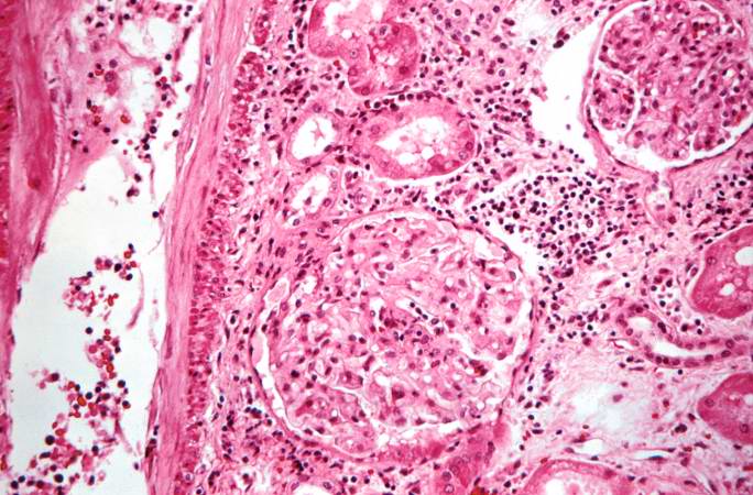 This high-power photomicrograph demonstrates the cellular infiltrate within the interstitium and in the wall of the blood vessel on the left.