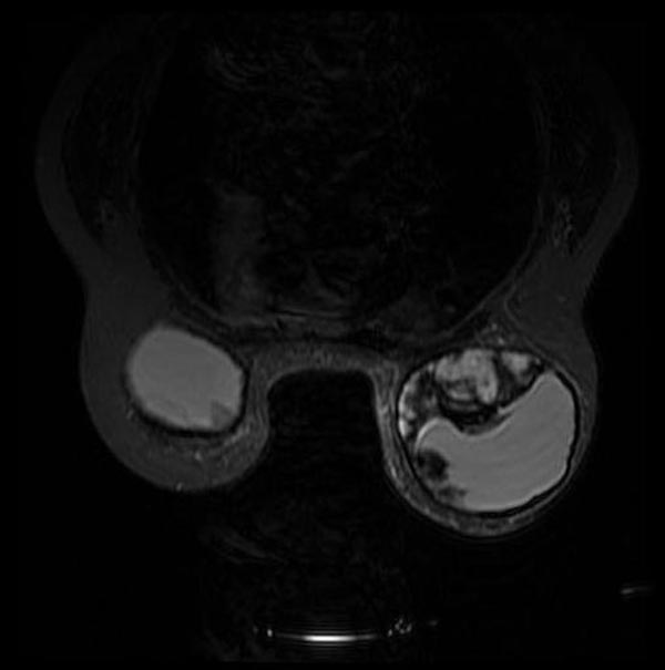 MRI: Breast implant rupture: Intracapsular rupture