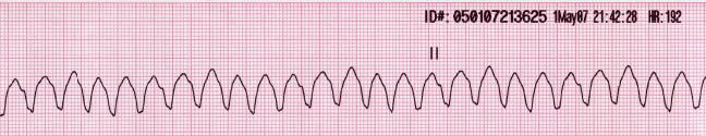 Lead II rhythm ventricular tachycardia Vtach VT.jpg