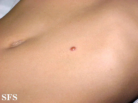 Juvenile xanthogranuloma. With permission from Dermatology Atlas.<ref