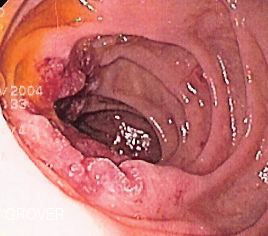 Duodenal adenocarcinoma.png